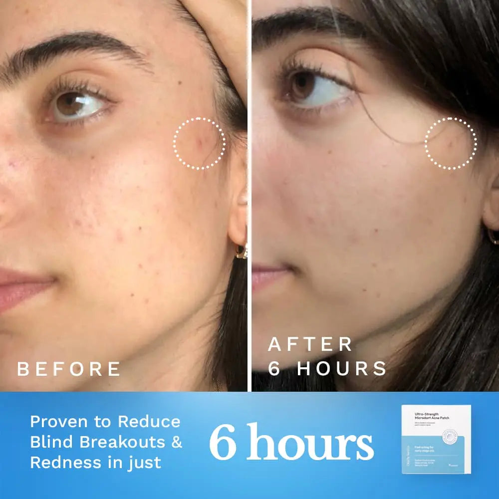 Ultra-Strength Microdart Acne Patch
